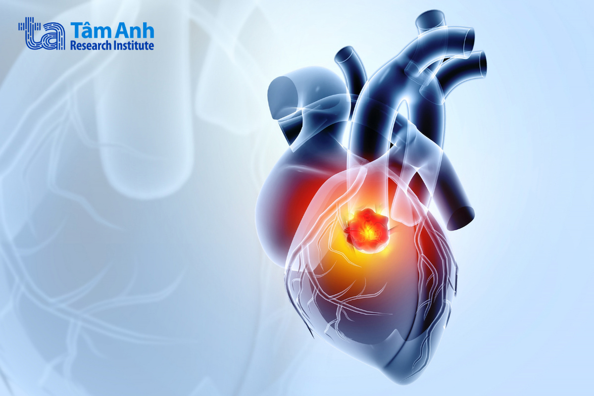 Ung thư tim nguyên phát rất hiếm gặp, phần lớn các trường hợp được phát hiện thường là ung thư nguyên phát hoặc di căn